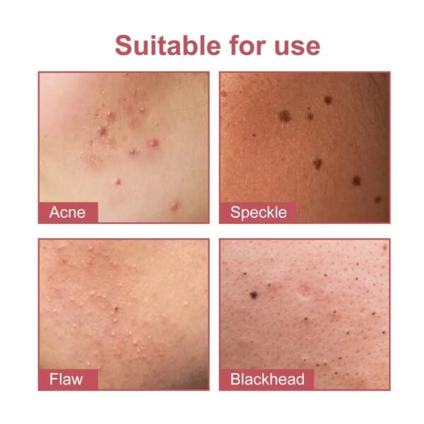 144pcs Colorful Star Acne Patches: Fade Pimple Marks, Clean Pores, Smooth Skin, Portable Pentagram Design