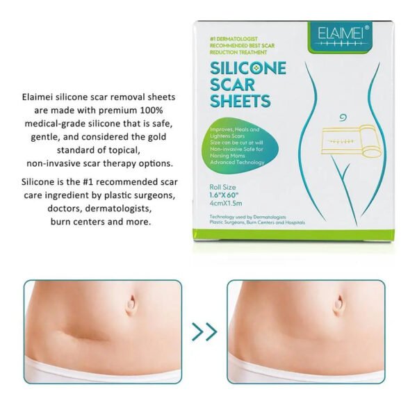 150cm Silicone Gel Scar Sheet Patch Treatment Cover Skin Repair Removal Tape for Acne, Burn Scar