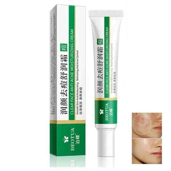Herbal Acne Face Scar Treatment Cream   Blackhead Remover Repair Gel -Oil Control /Shrink Pores /Whitening Korean Skin Care