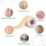 150cm Silicone Gel Scar Sheet Patch Treatment Cover Skin Repair Removal Tape for Acne, Burn Scar